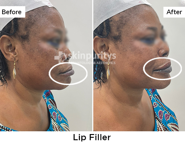 Lip Filler results